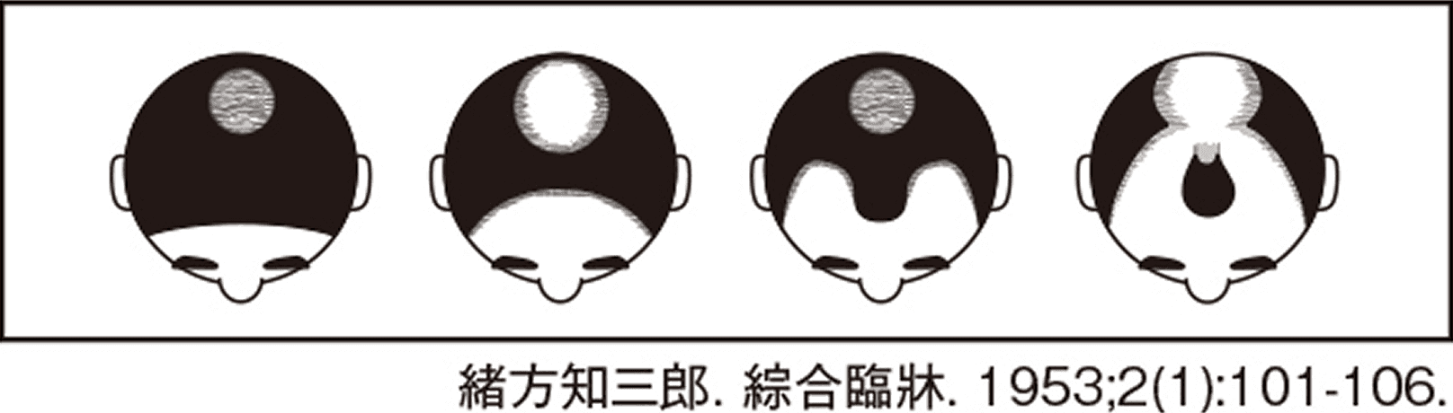 Promotes hair growth, strengthens hair, and prevents the progression of hair loss in cases of androgenetic alopecia.